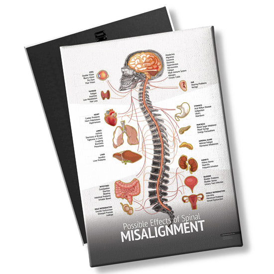 Spine Misalignment Chart - Chiropractic Patient Education Poster ...