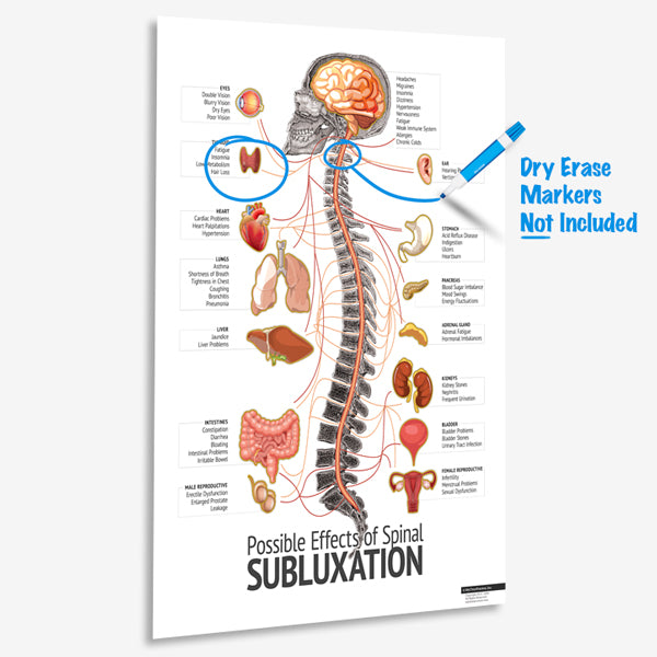 Subluxation Chart on Acrylic - For Dry Erase Markups - MyChiroPractice | Chiropractic Posters